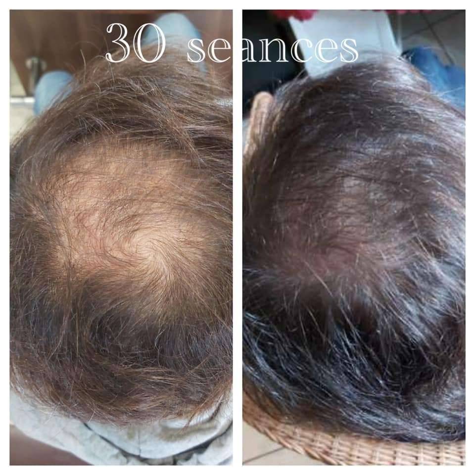 avant après électrostimulation chute de cheveux