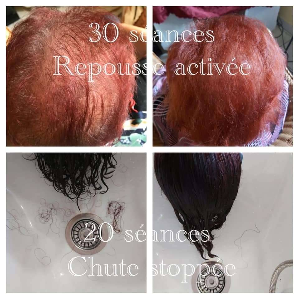 avant après électrostimulation chute de cheveux